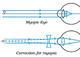 Noopur needs a lens of power -4.5D for correction of her vision. a) What kind of defect in vision is she suffering from? b) What is the focal length and nature of the corrective lens? c) Draw ray diagrams showing the (a) defected eye and (b) correction for this defect. d) What are the causes of this defect?